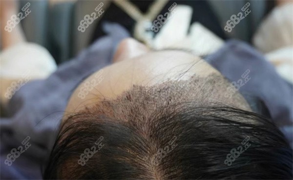东莞科生植发实例3