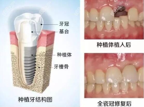 石家庄普爱口腔门诊种植牙补牙优势