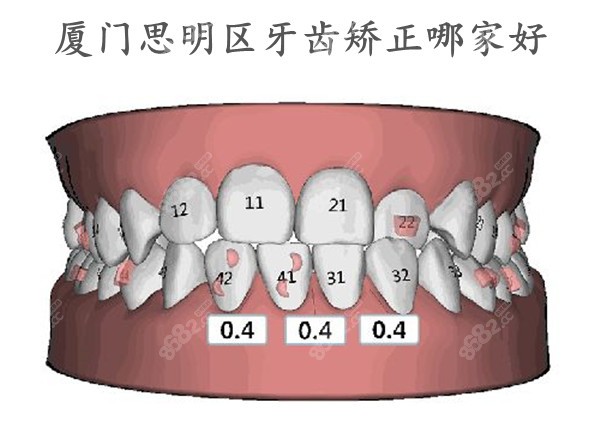 <!--<i data=20240705-sp></i>-->区牙齿矫正哪个好