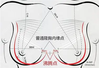 沸腾丰胸术内缘点比普通丰胸术更深入