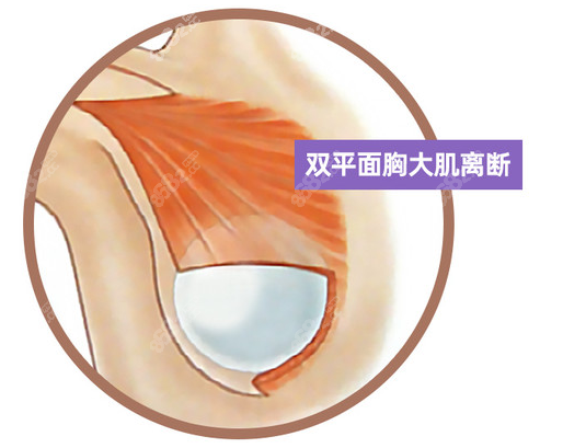 王晓健做内窥镜双平面隆胸手术