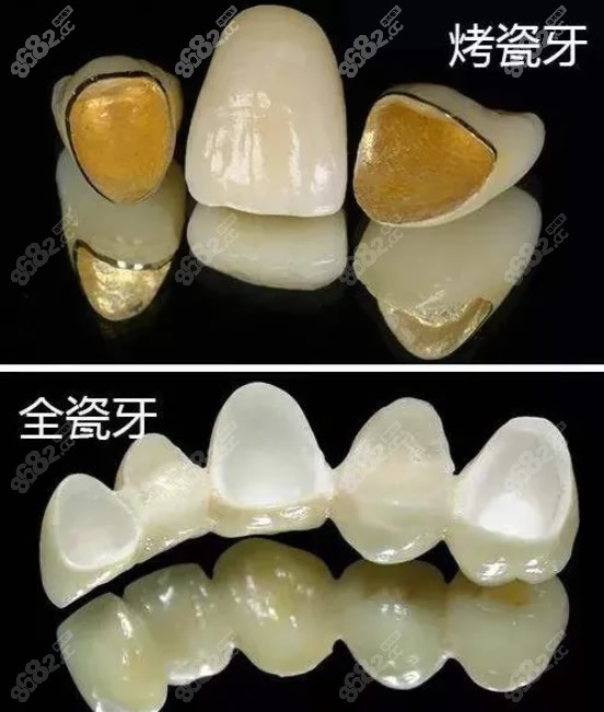 全瓷牙和烤瓷牙区别