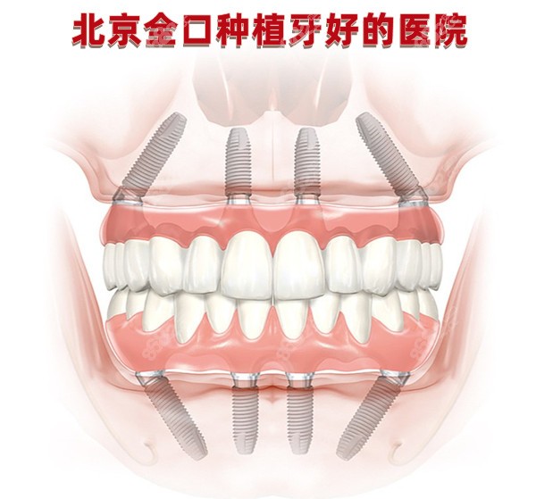 北京全口种植牙好的医院