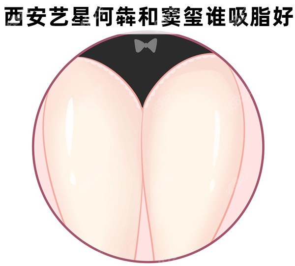 西安艺星何犇和窦玺谁吸脂好