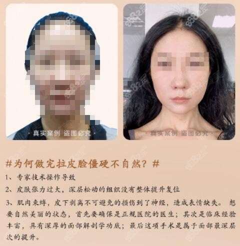 北京加減美面部提升術后