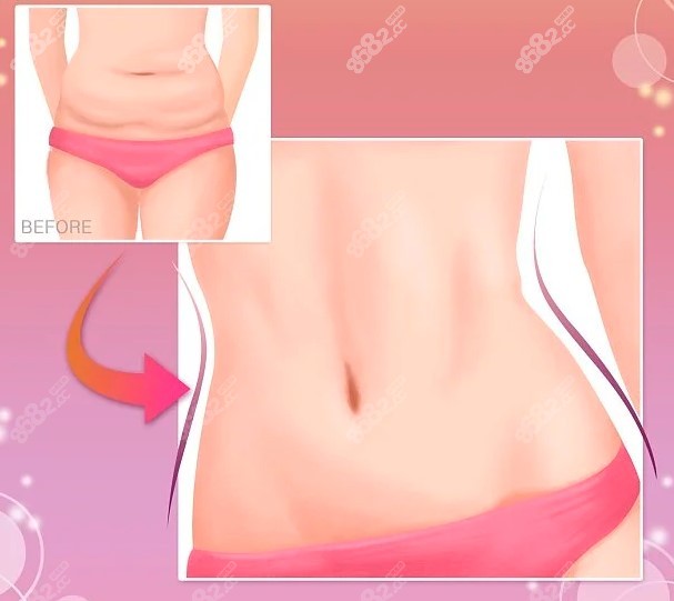 腰腹吸脂