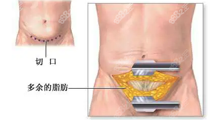 西安腹壁成形术多少钱