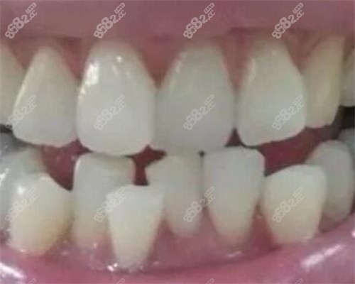 北京禾禾齿科正畸前