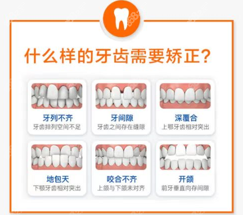 兰州德尔牙科常做的牙齿矫正类型图