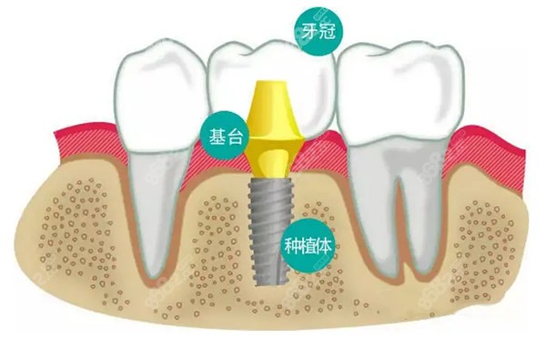 种植牙图片