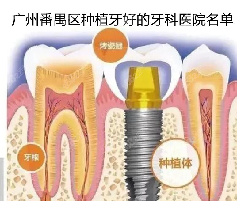 广州番禺区种植牙好的牙科医院名单