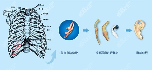 肋软骨直埋耳再造术