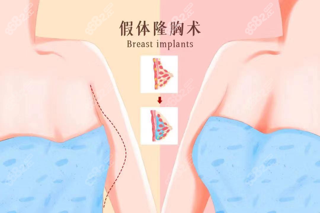 济南假体隆胸哪个医院好