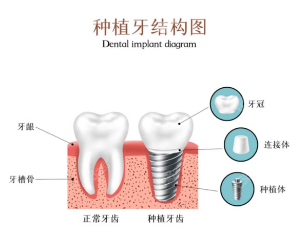 种植牙由植体基台和牙冠三部分组成