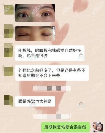 济南白永辉双眼皮修复顾客反馈