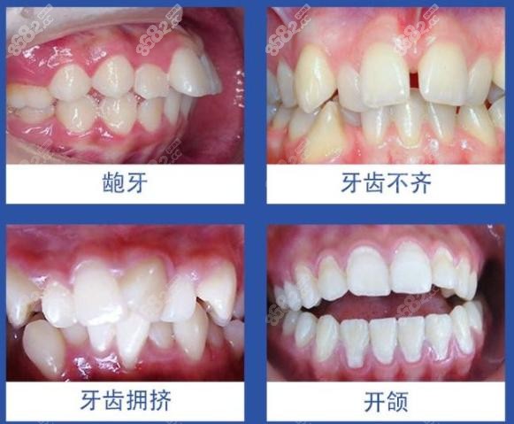 上海朗朗口腔牙齿矫正适应人群