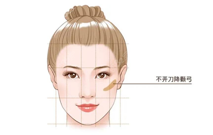 这是不开刀降颧骨