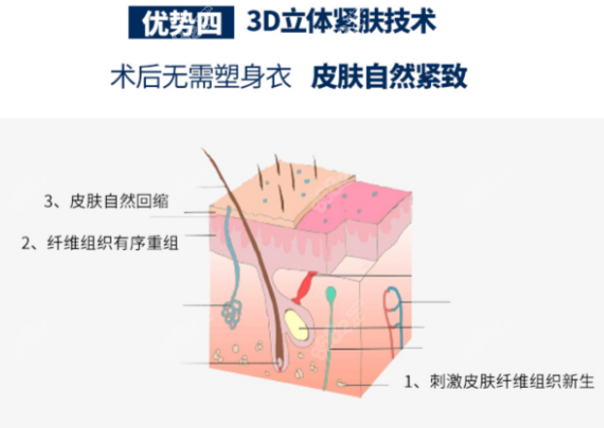 土麦森吸脂优势