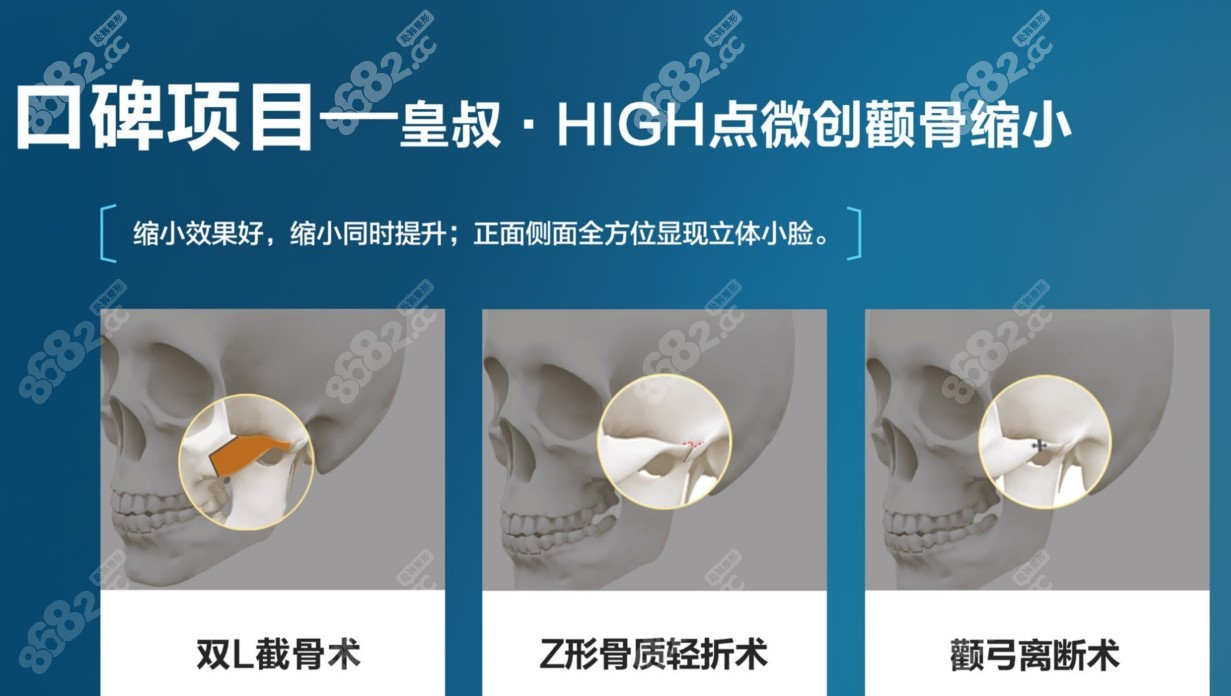 黄大勇磨骨怎么样