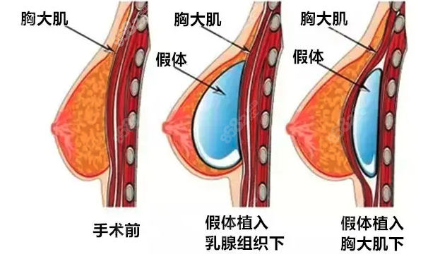 王爱武假体隆胸技术过硬