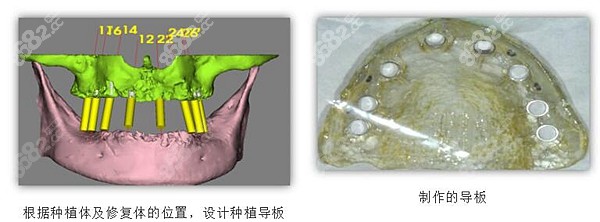 株洲南光口腔医院做种植牙的价格