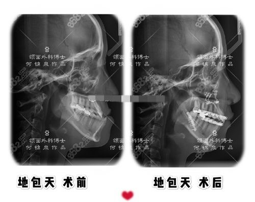 地包天前后对比