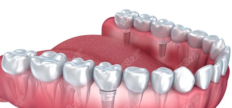 东莞半口种植牙价格表