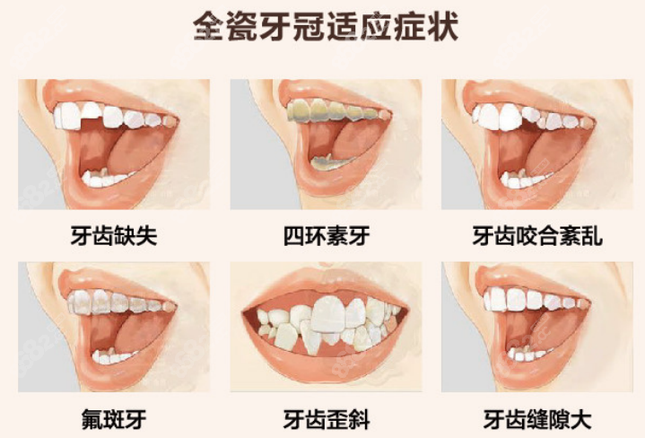 贝杰口腔医院全瓷牙收费