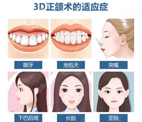 正颌手术适应症