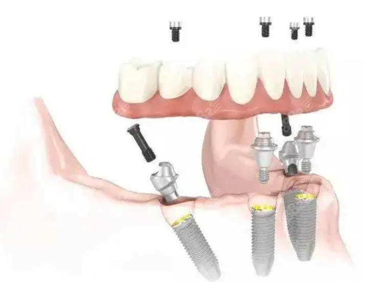 半固定种植牙的优缺点及价格