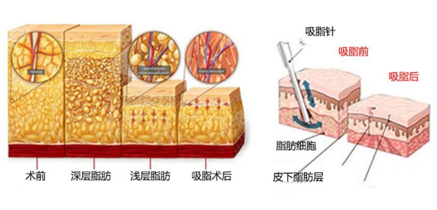 土麦森吸脂技术原理