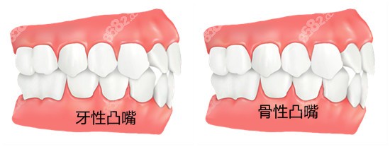 南京正颌手术费用和凸嘴原因有关
