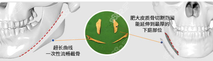 长曲线截骨量