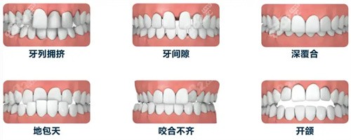 牙齿需要矫正的类型