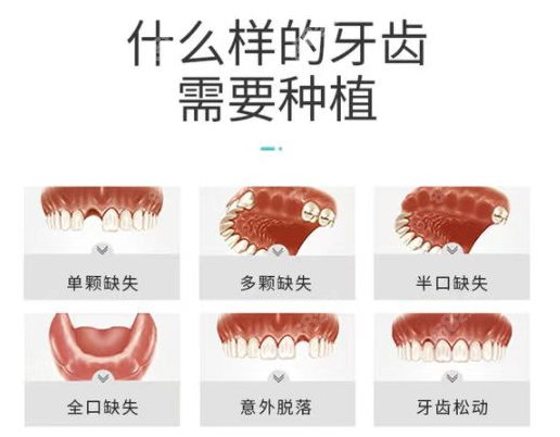 南宁岭南口腔做种植牙的类型图