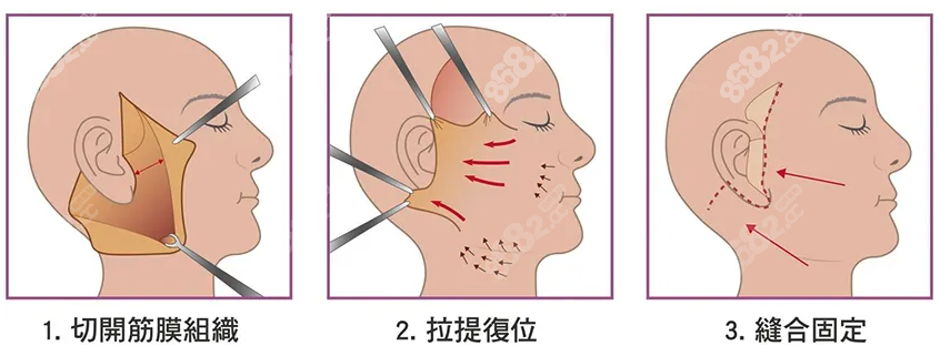 西安拉皮医生哪个做得好