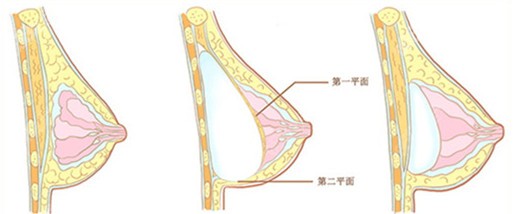 南京假体隆胸哪家好？