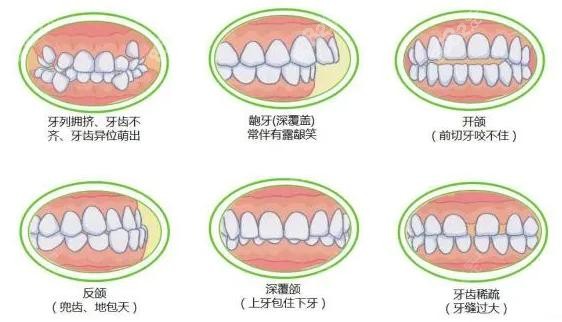 牙畸形示意图