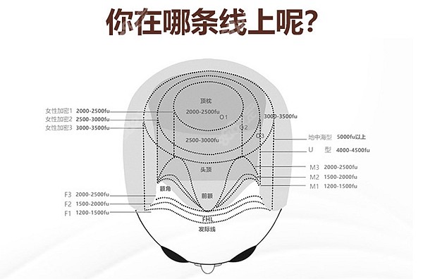 毛发移植种植价格表