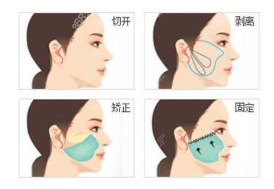 小拉皮除皱过程示意图