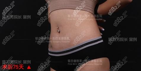陈万芳云柔吸脂术后