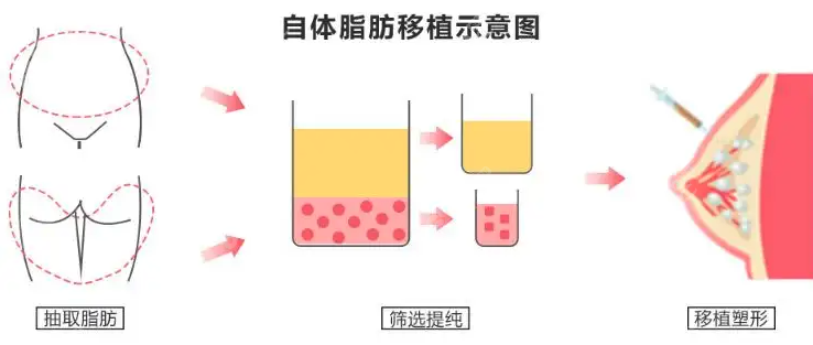 西安自体脂肪隆胸哪家好