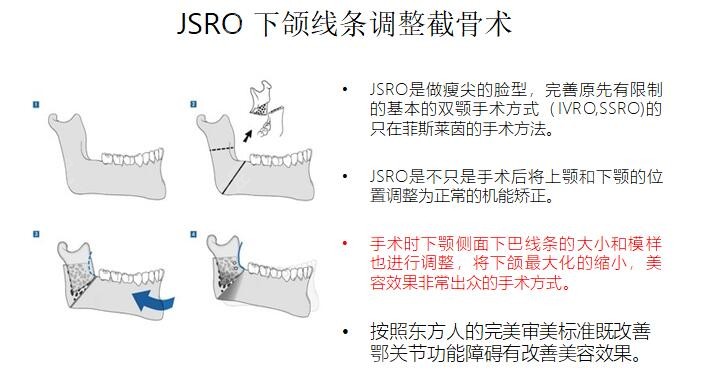 菲斯莱茵做下颌角磨骨手术的优势点
