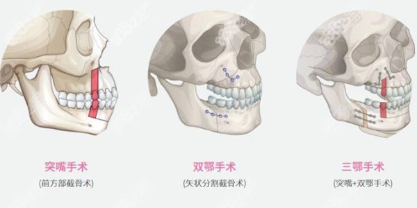 正颌手术的不同术式