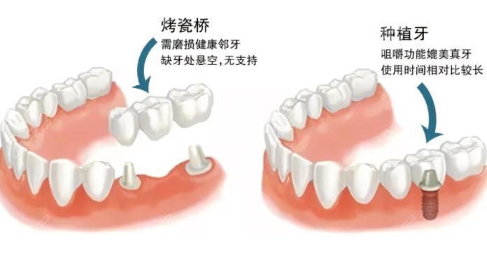 镶烤瓷牙和种植牙区别