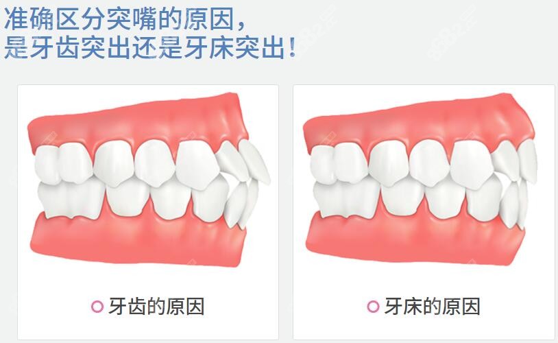 凸嘴还分齿性和骨性