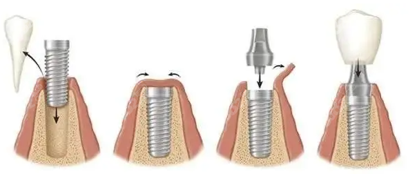 东莞固德口腔种植牙过程