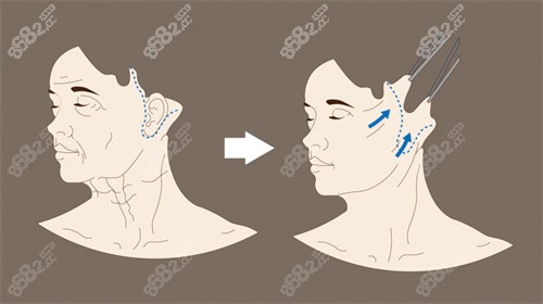 魔法超拉皮可以维持多久？