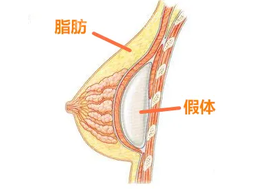 东莞西妃整形复合丰胸