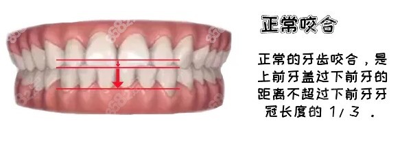 正常咬合.jpg